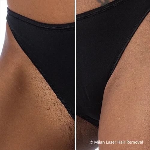 how much does laser hair removal cost in miami｜TikTok Search